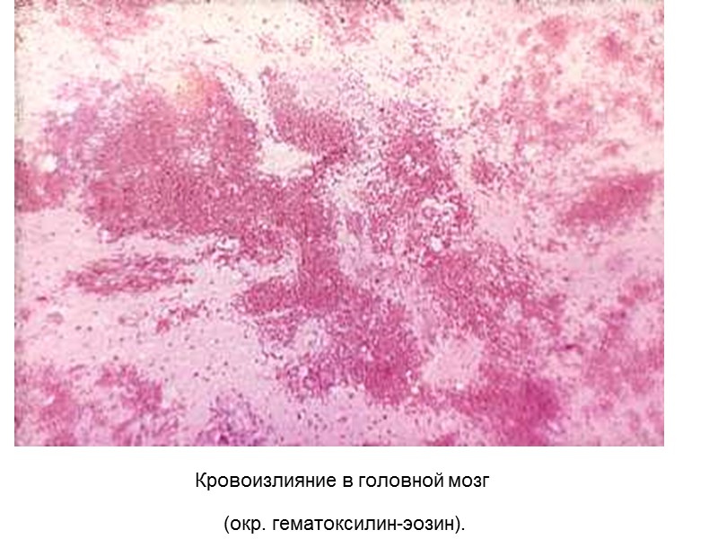 Кровоизлияние в головной мозг  (окр. гематоксилин-эозин).